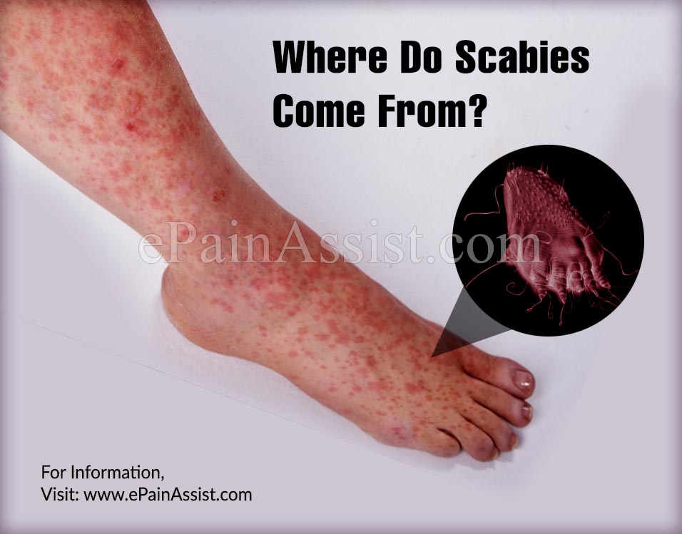 Where Do Scabies Come From?