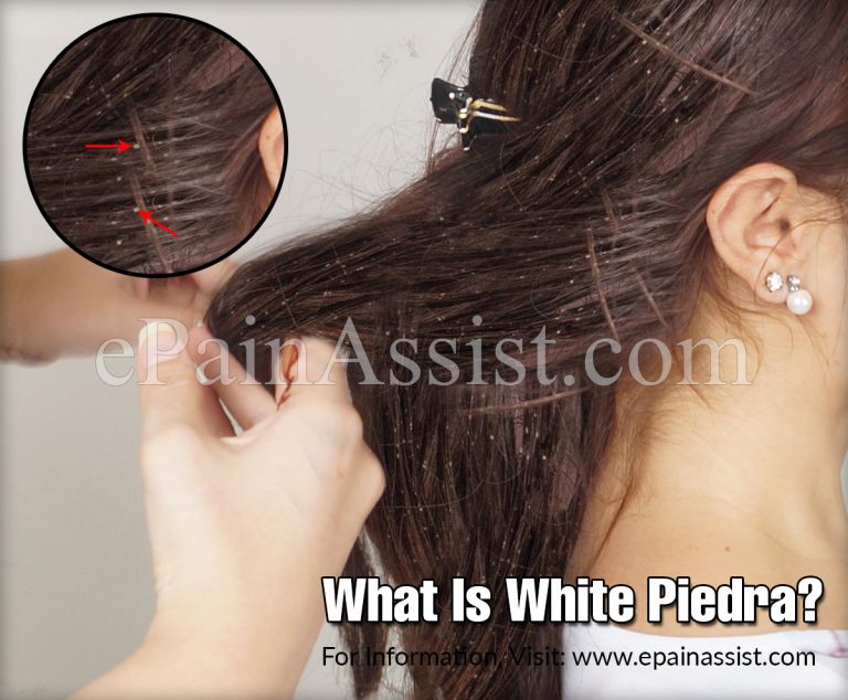 White Piedra: Causes, Symptoms, Treatment, Diagnosis