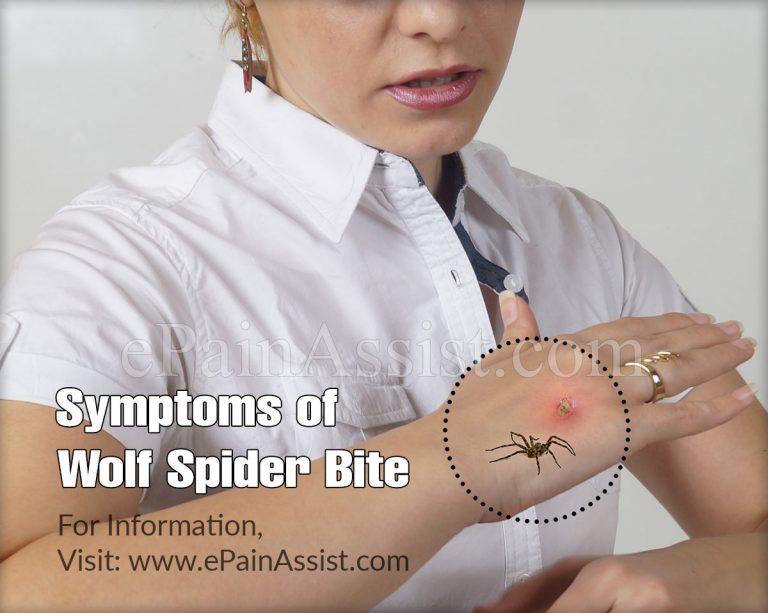Wolf Spider Bite: Symptoms, Treatment, Prevention, Diagnosis