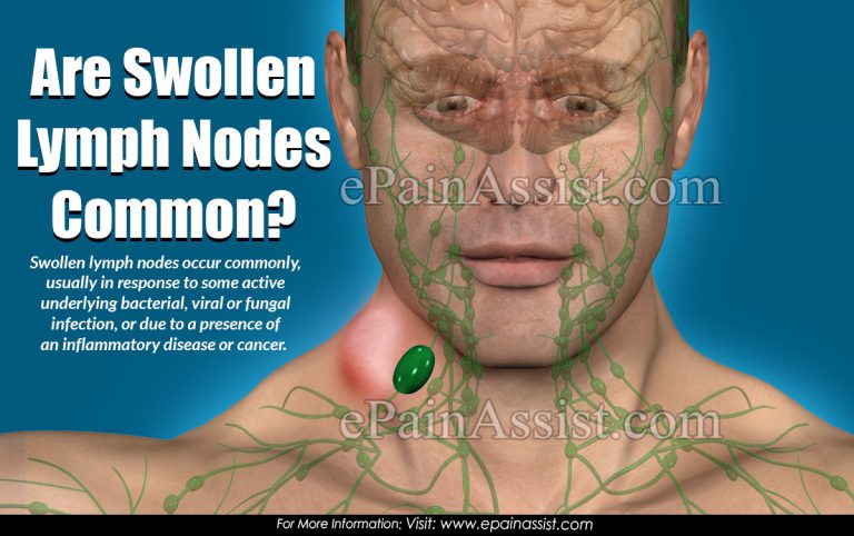 Are Swollen Lymph Nodes Common?