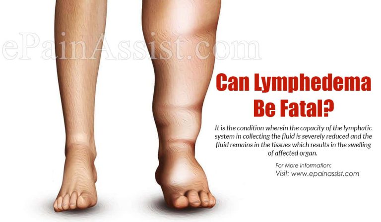 Can Lymphedema Be Fatal?