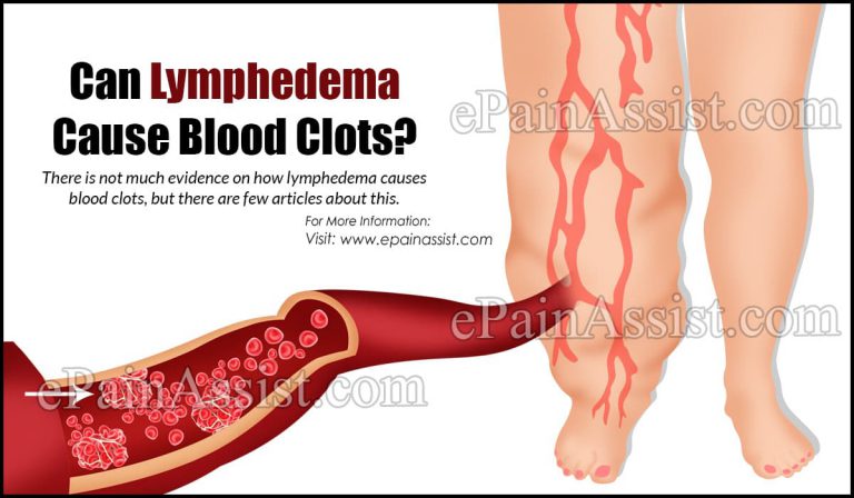 Can Lymphedema Cause Blood Clots?