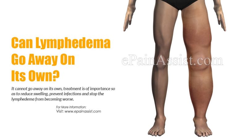 Can Lymphedema Go Away On Its Own?