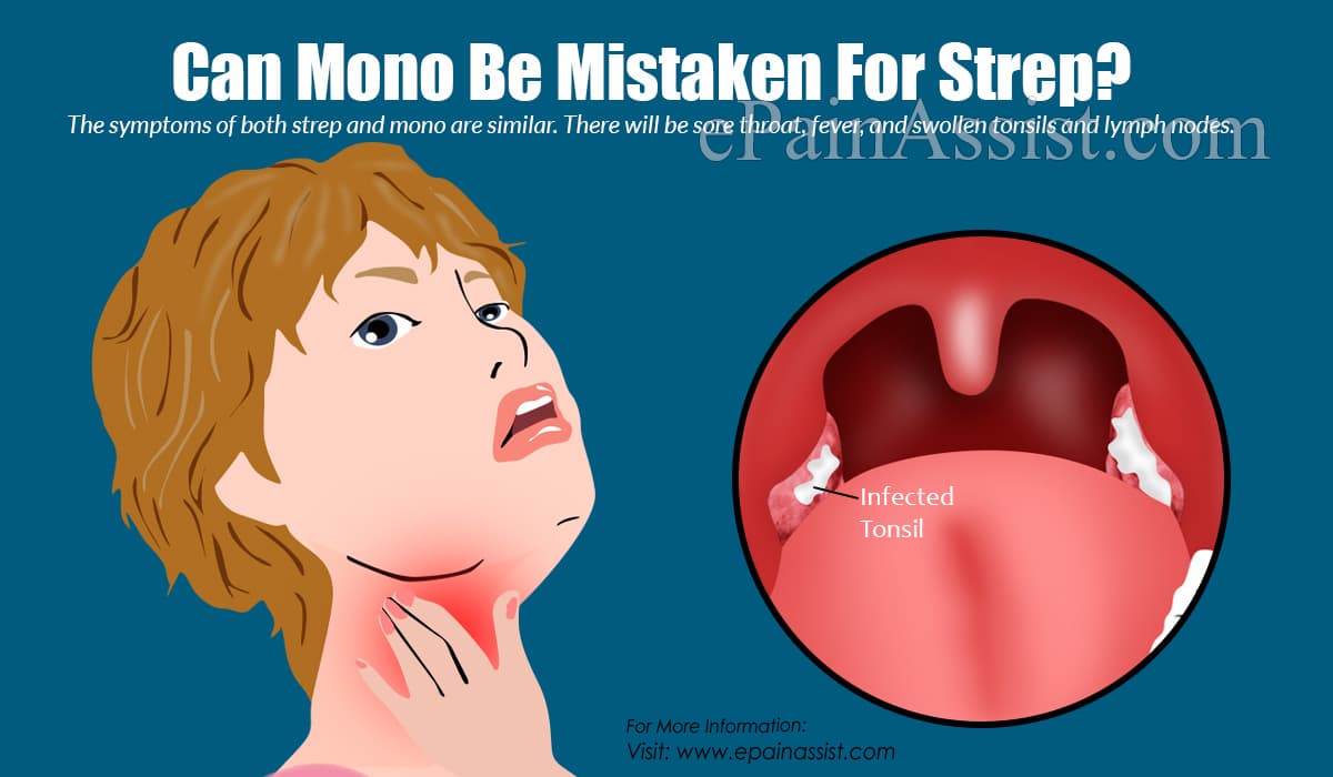 Can Mono Be Mistaken For Strep?