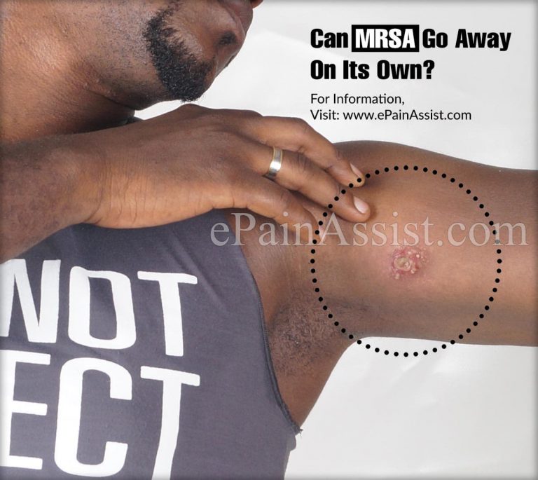 Can MRSA Go Away On Its Own?