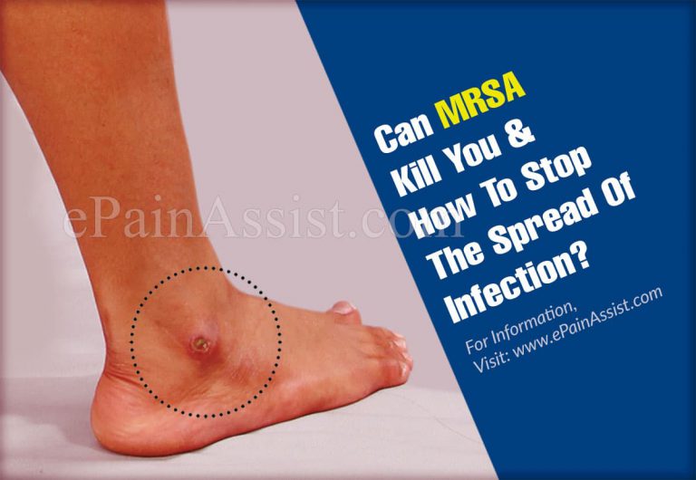 Can MRSA Kill You & How To Stop The Spread Of Infection?