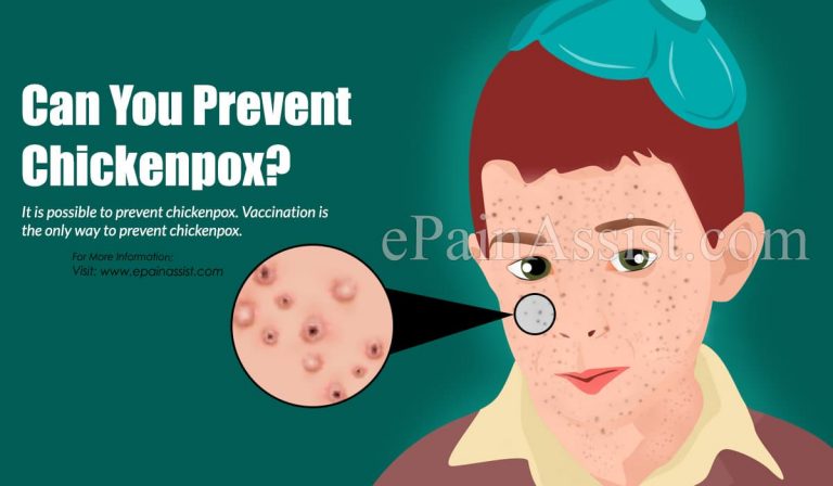 Can you Prevent Chickenpox & What Can Help Relieve Its Symptoms?
