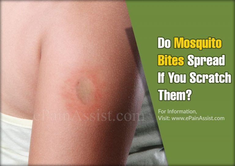 Do Mosquito Bites Spread If You Scratch Them?