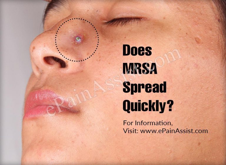 Does MRSA Spread Quickly?