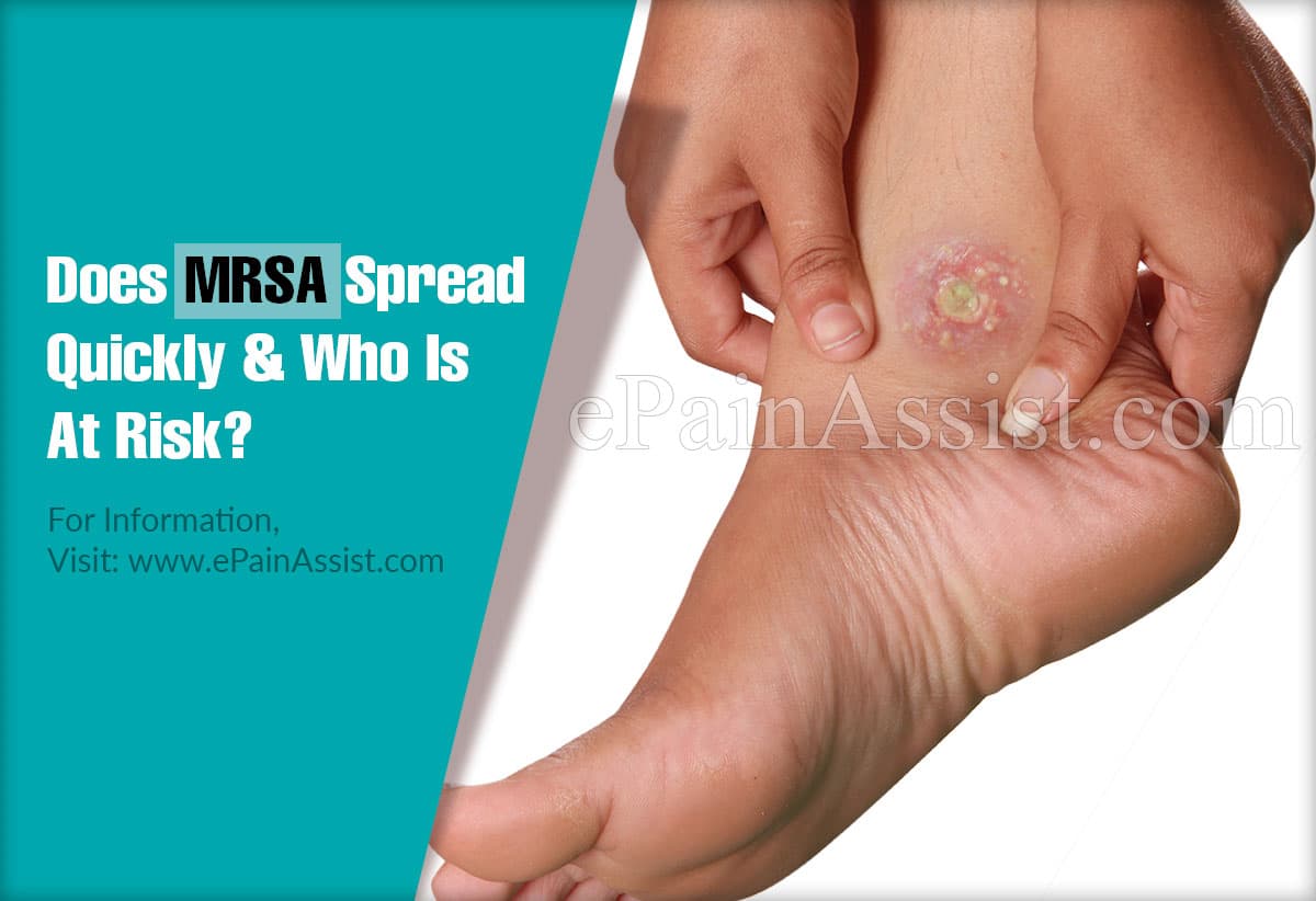 Does MRSA Spread Quickly & Who Is At Risk?