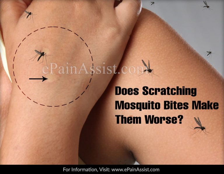 Does Scratching Mosquito Bites Make Them Worse?