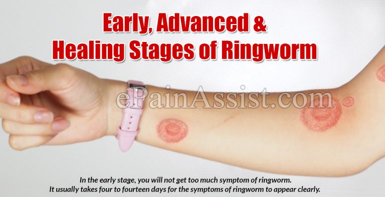 Early, Advanced, Healing Stages of Ringworm