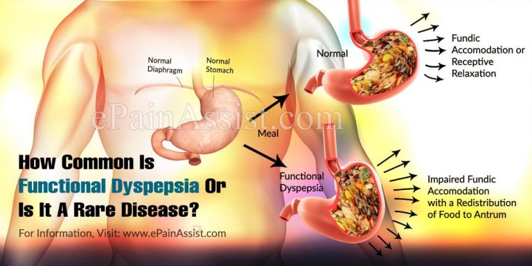 How Common Is Functional Dyspepsia Or Is It A Rare Disease?