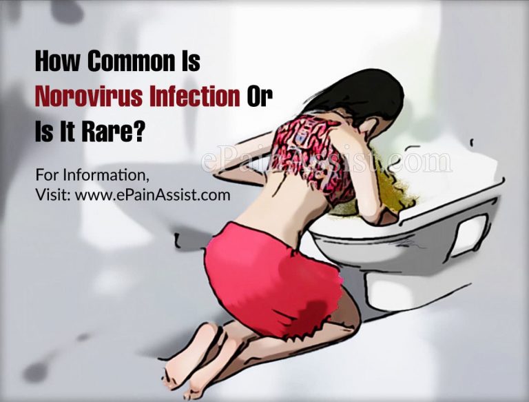 How Common Is Norovirus Infection Or Is It Rare?