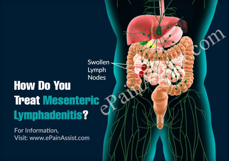 How Do You Treat Mesenteric Lymphadenitis?