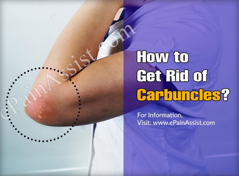 How to Get Rid of Carbuncles?