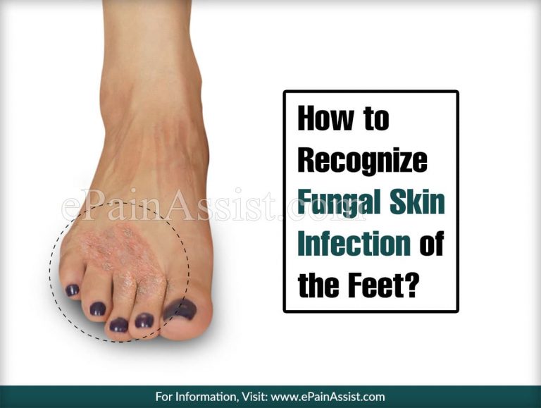Recognizing Fungal Infection of the Feet & Its Treatment and Prevention