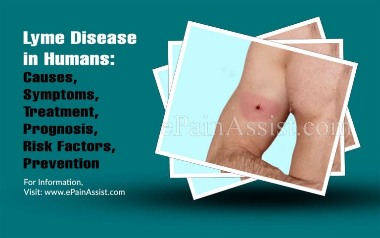 Lyme Disease in Humans: Causes, Symptoms, Treatment, Prognosis, Risk Factors, Prevention