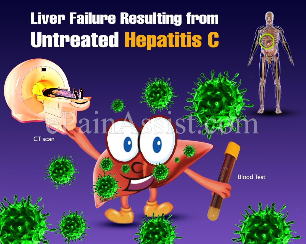 What are the Long-Term Effects of Untreated Hep C?