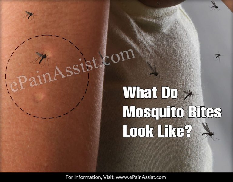 What Do Mosquito Bites Look Like?