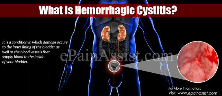 Hemorrhagic Cystitis: Causes, Symptoms, Treatment, Risk Factors, Diagnosis