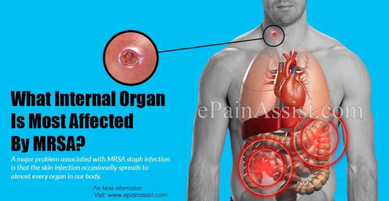 What Internal Organ Is Most Affected By MRSA?