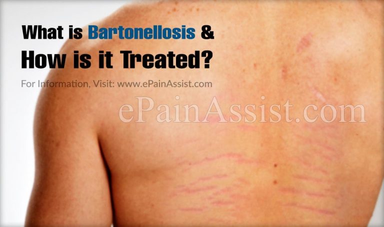 What is Bartonellosis & How is it Treated?|Types, Epidemiology, Diagnosis of Bartonellosis