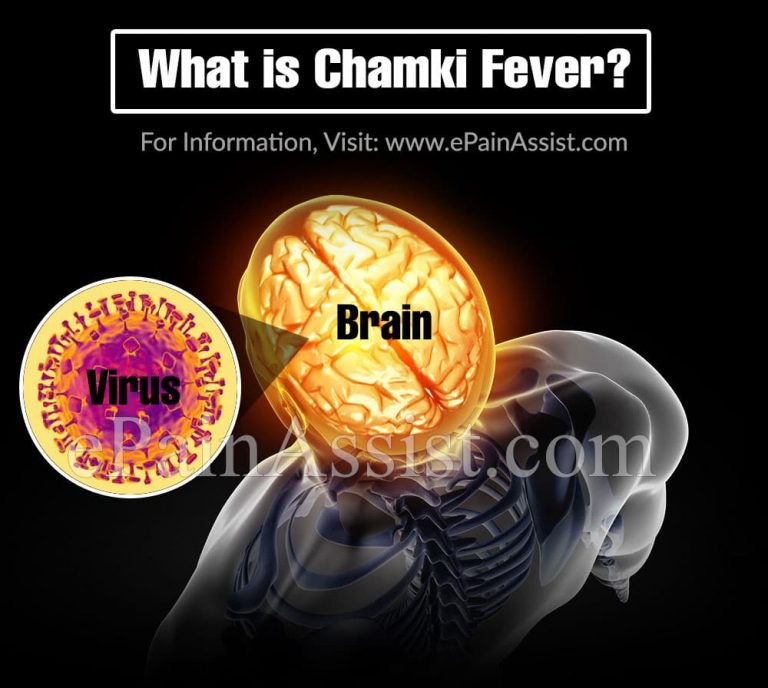 What is Chamki Fever & How is it Treated?|Causes, Symptoms. Prevention of Chamki Fever