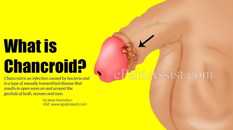 What is Chancroid & How is it Treated | Causes, Symptoms, Risk Factors, Prognosis of Chancroid