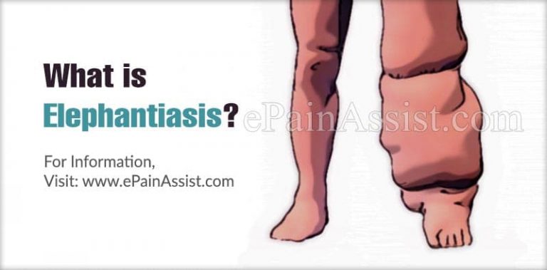 Elephantiasis: Causes, Symptoms, Treatment, Diagnosis
