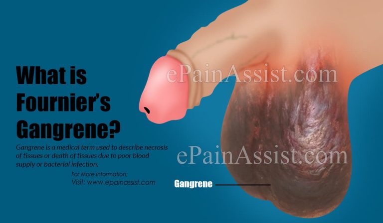 What is Fournier’s Gangrene & How is it Treated?|Causes, Symptoms, Prognosis, Prevalence of Fournier’s Gangrene