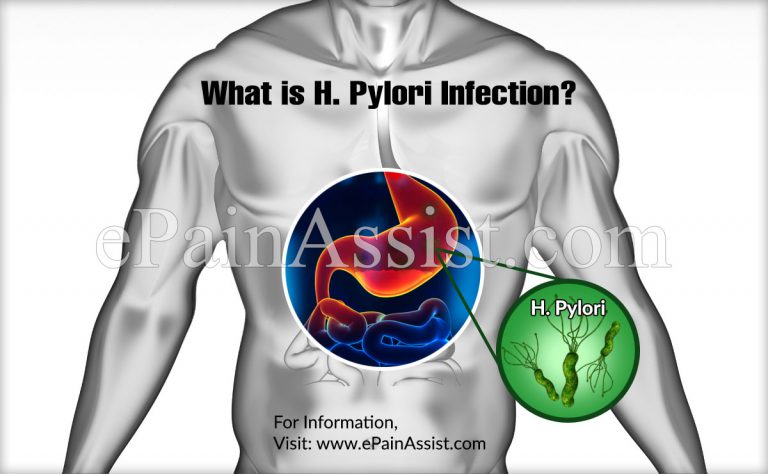 What is H. Pylori Infection: Causes, Symptoms, Diagnosis, Treatment