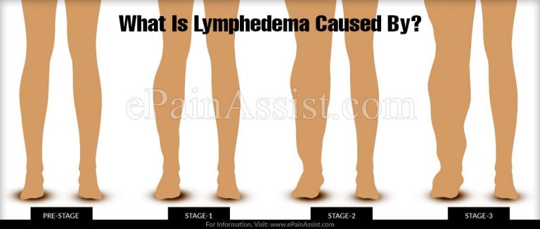 What Is Lymphedema Caused By?