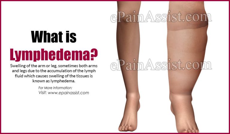 Lymphedema: Types, Symptoms, Causes, Treatment, Diagnosis, Precautions