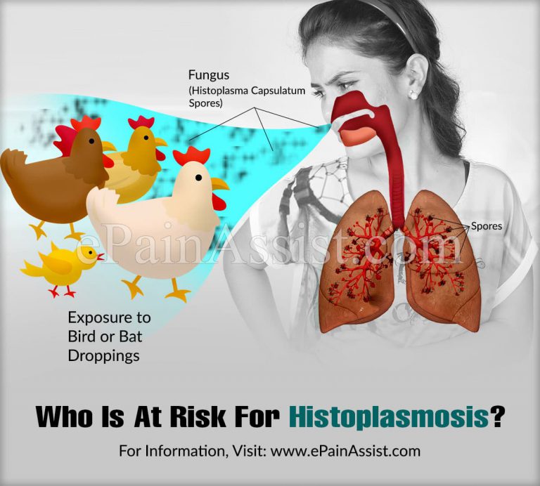 Who Is At Risk For Histoplasmosis?