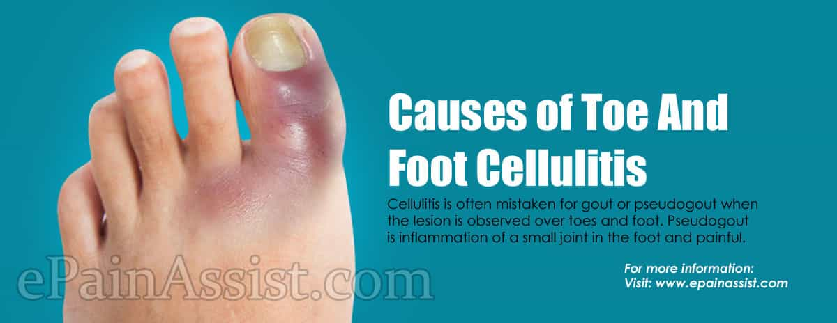 Causes of Toe And Foot Cellulitis