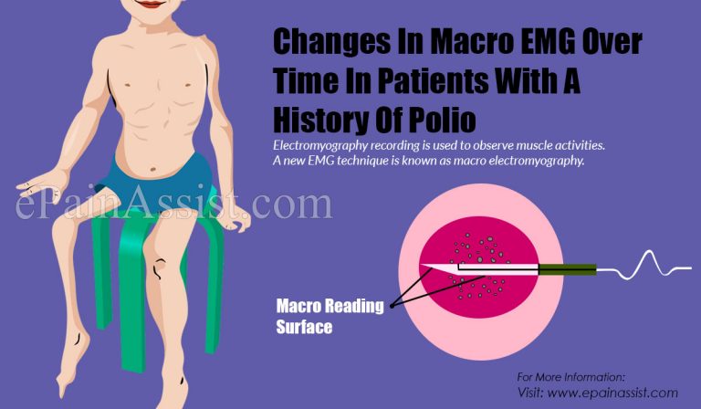 Changes In Macro EMG Over Time In Patients With A History Of Polio