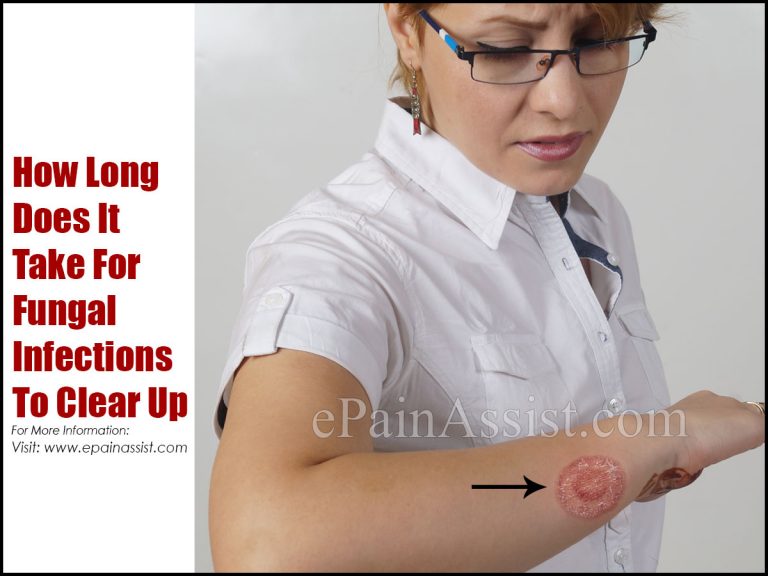 How Long Does It Take For Fungal Infections To Clear Up?