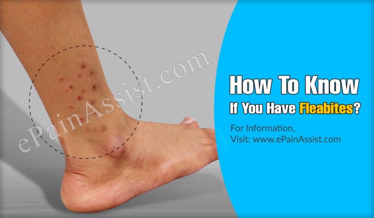 Fleabites: Symptoms, Identification, Treatment