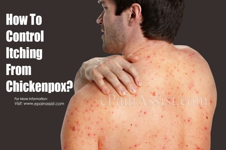 How To Control Itching From Chickenpox?