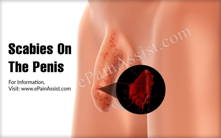 Symptoms Of Scabies On The Penis & Its Treatment