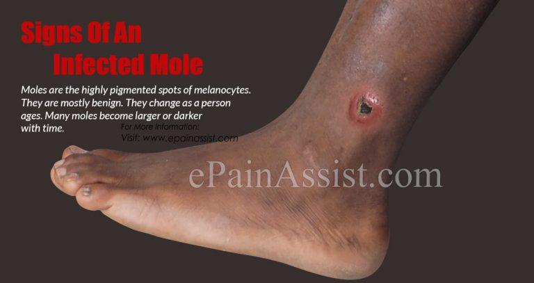 Signs of an Infected Mole, Its Causes, Treatment and Prevention