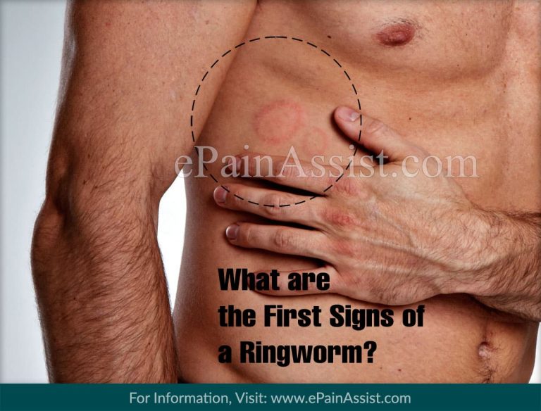 What Are the First Signs of a Ringworm & What Happens if Ringworm is Not Treated?