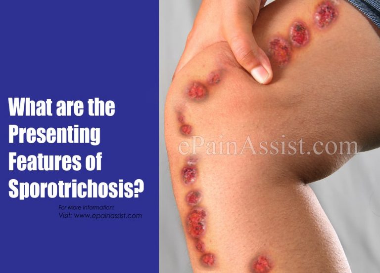 What are the Presenting Features of Sporotrichosis & Can Sporotrichosis Go Away On Its Own?