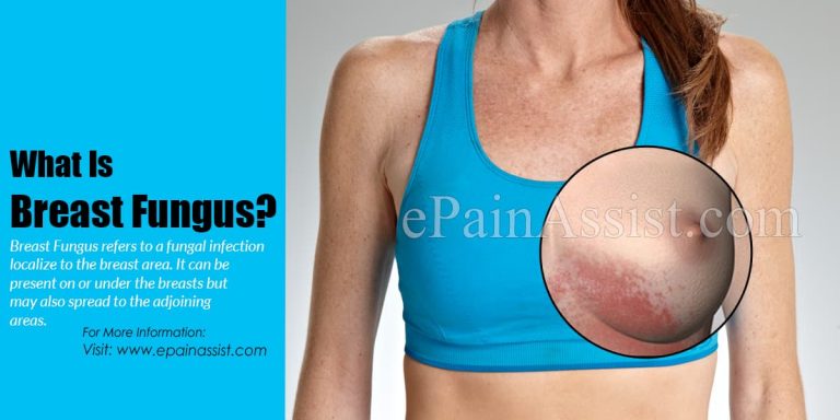 What Causes Breast Fungus & How is it Treated?|Symptoms, Complications, Prevention of Breast Fungus