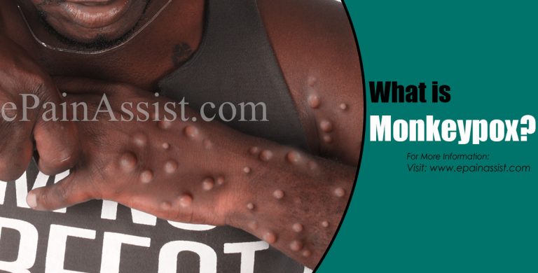 What is Monkeypox & How Long Does it Last? | Causes, Symptoms, Treatment and Prevention of Monkeypox