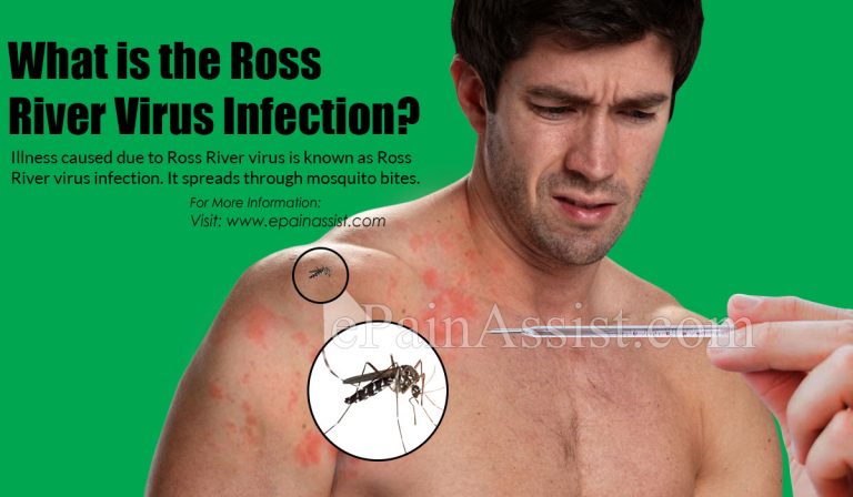 What is the Ross River Virus Infection & How Does It Spread?