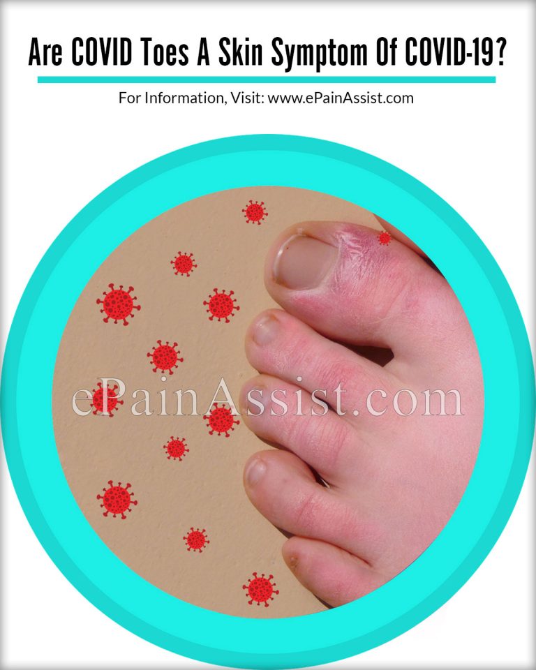 Are COVID Toes A Skin Symptom Of COVID-19?