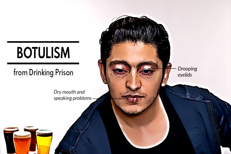Botulism from Drinking Prison-Made Illicit Alcohol