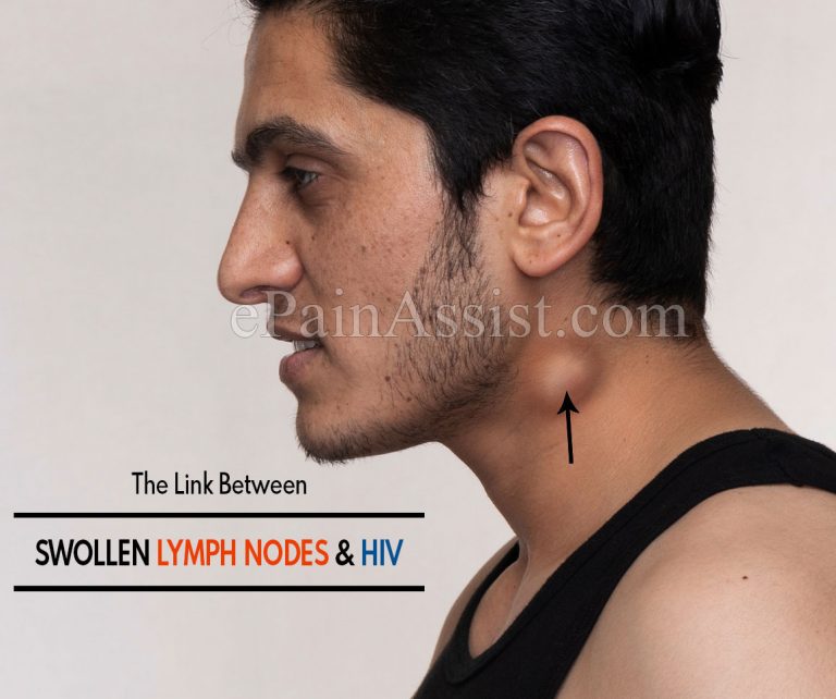 The Link Between Swollen Lymph Nodes and HIV